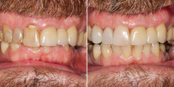 Ringwood Dental Discoloured and Mismatched Teeth Before and After
