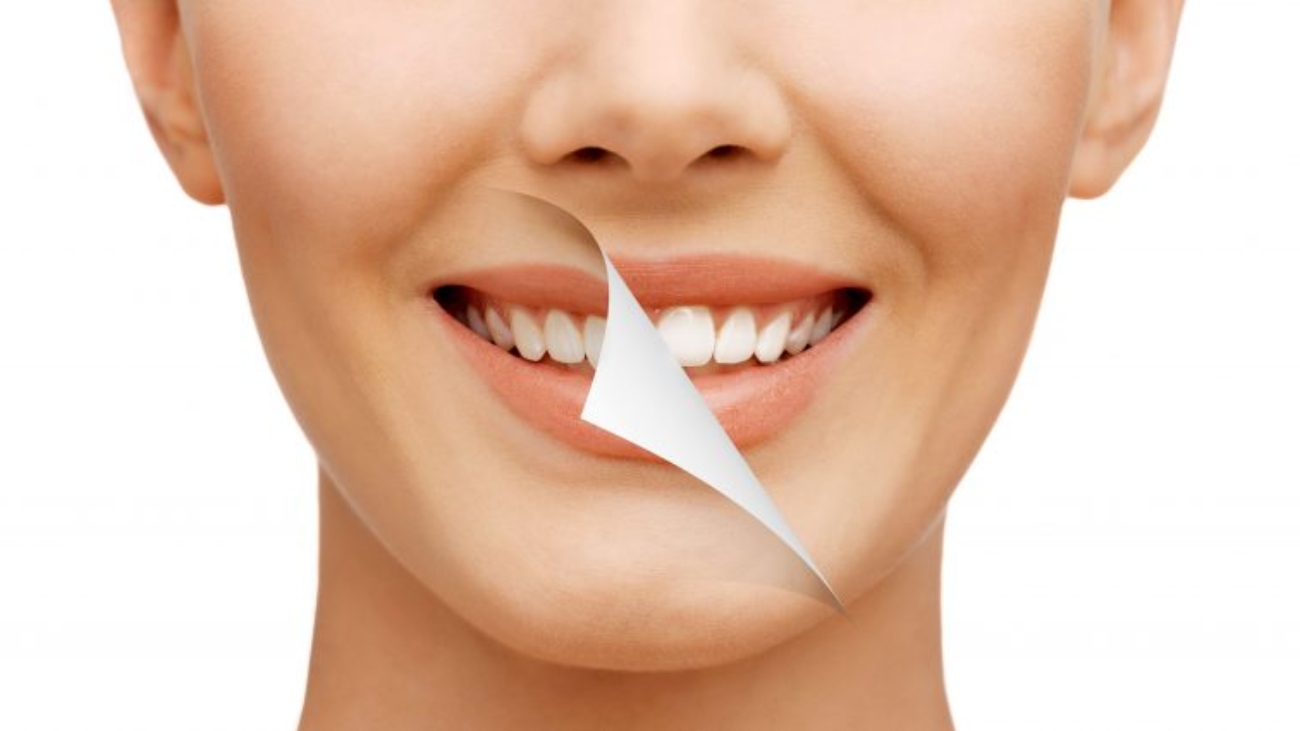 smile makeover