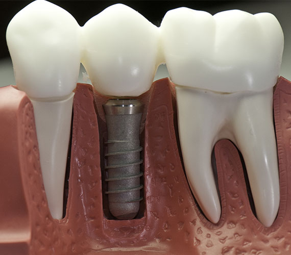 Dental Implant Ringwood