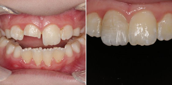Ringwood Dental Broken Tooth Before and After