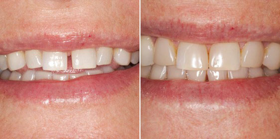 Ringwood Dental Gappy Smile Before and After