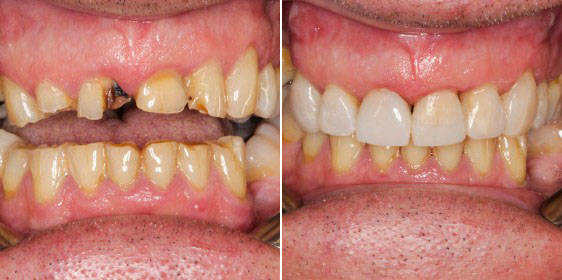Ringwood Dental Worn Teeth Before and After