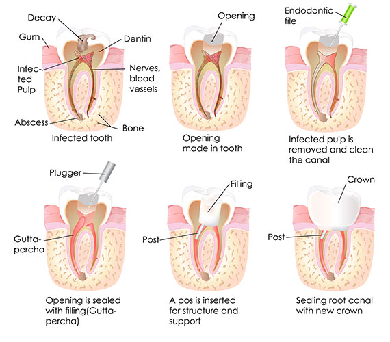 Root Canal Treatment Ringwood Dental