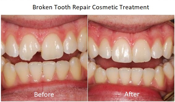 Broken Tooth Treatment Ringwood Dental Clinic