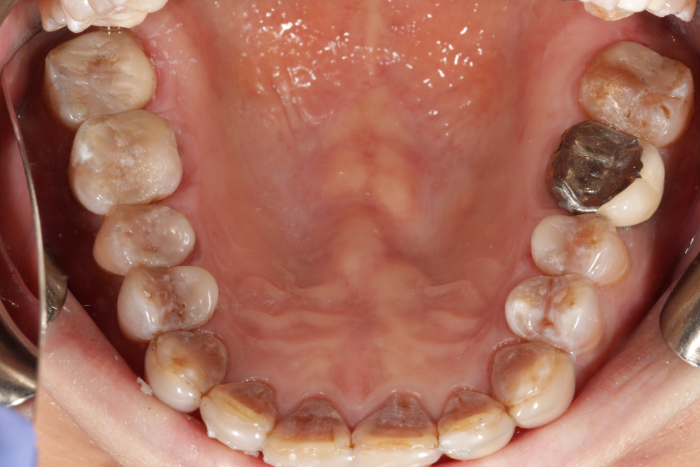 Worn Teeth