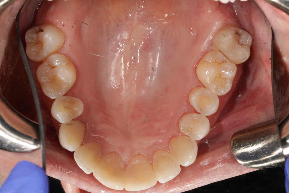 Worn Teeth