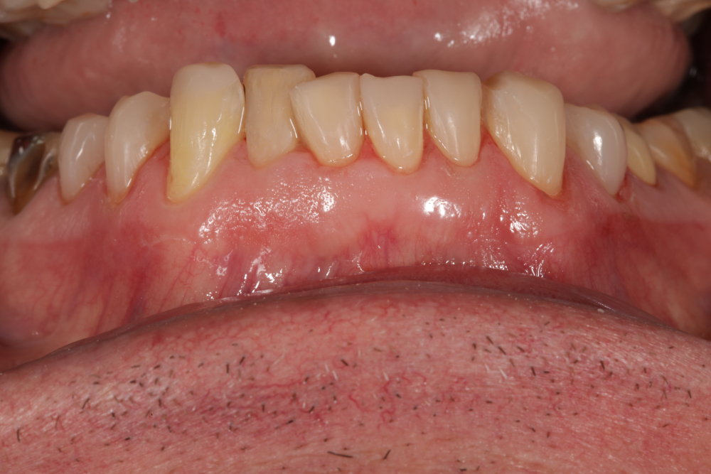 Worn Teeth