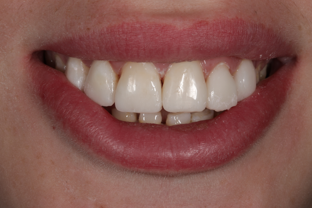Worn Teeth