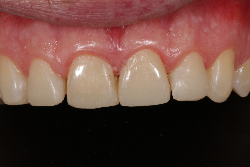 Worn Teeth