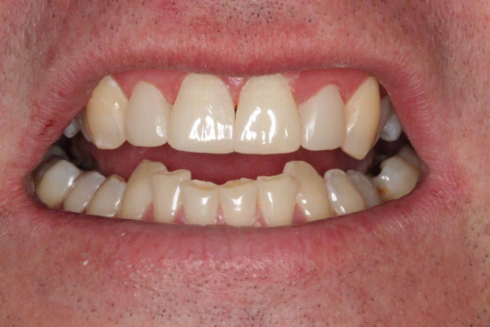 Worn Teeth