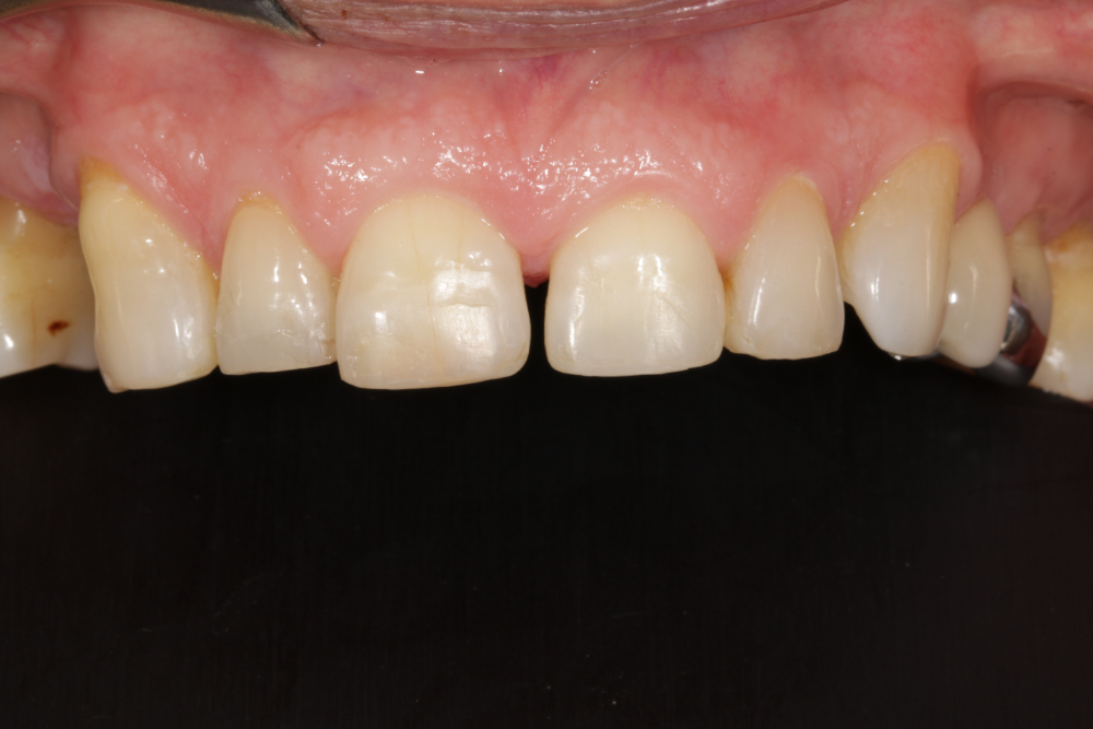 Worn Teeth