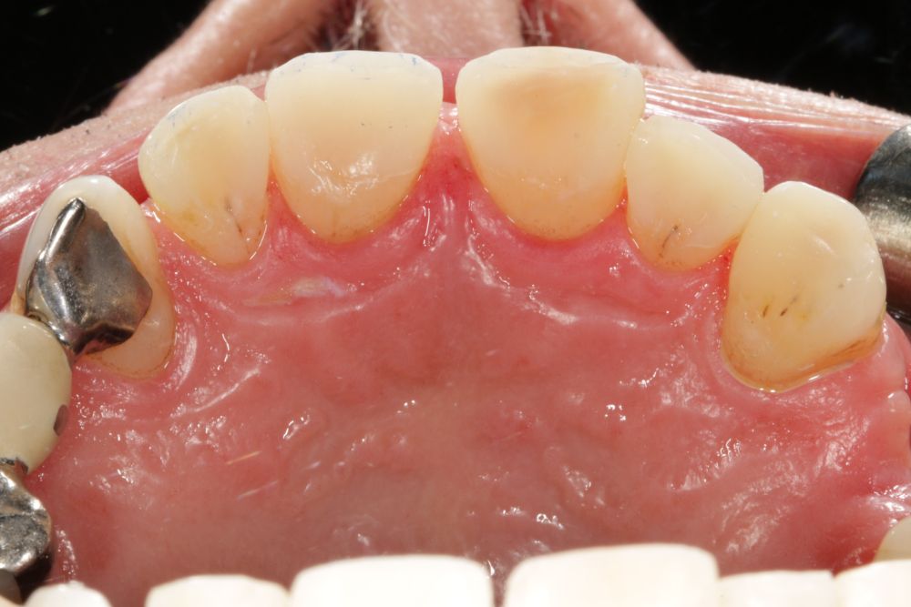 Worn Teeth