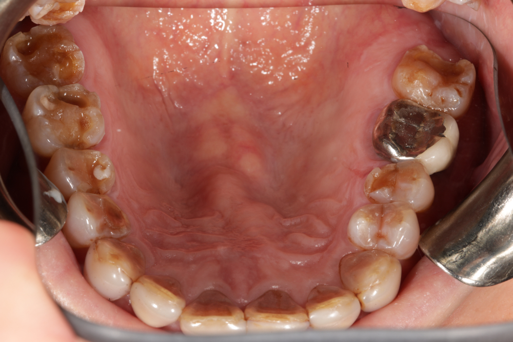 Worn Teeth