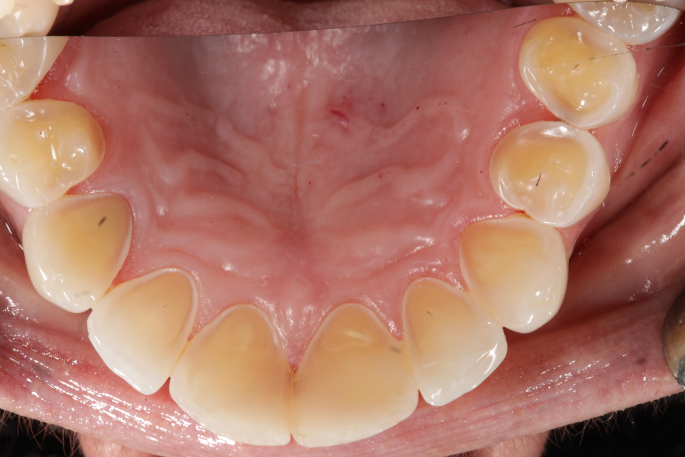 Worn Teeth