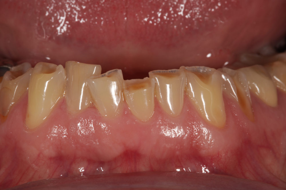 Worn Teeth