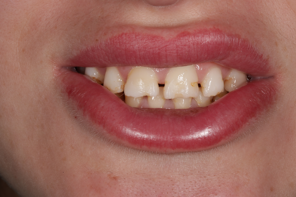 Worn Teeth