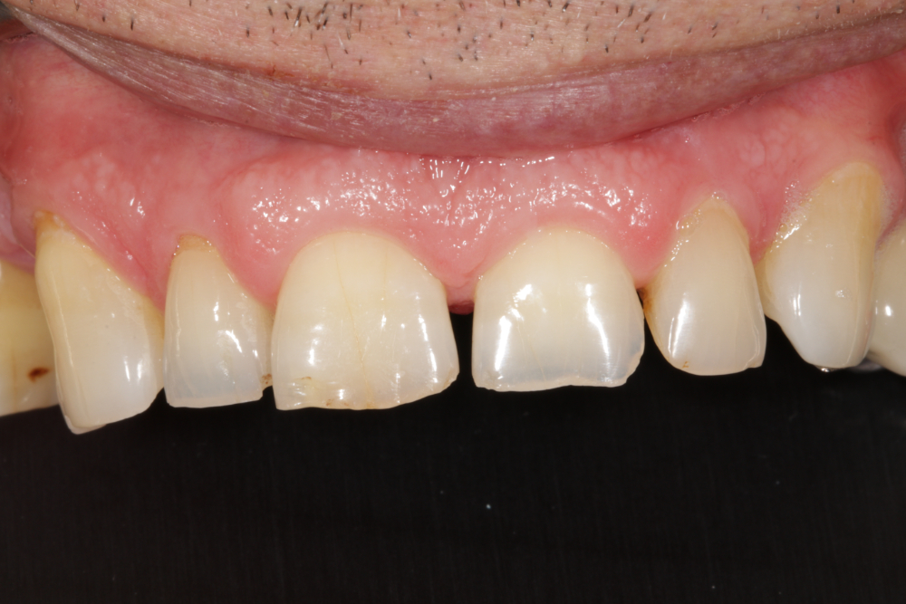 Worn Teeth