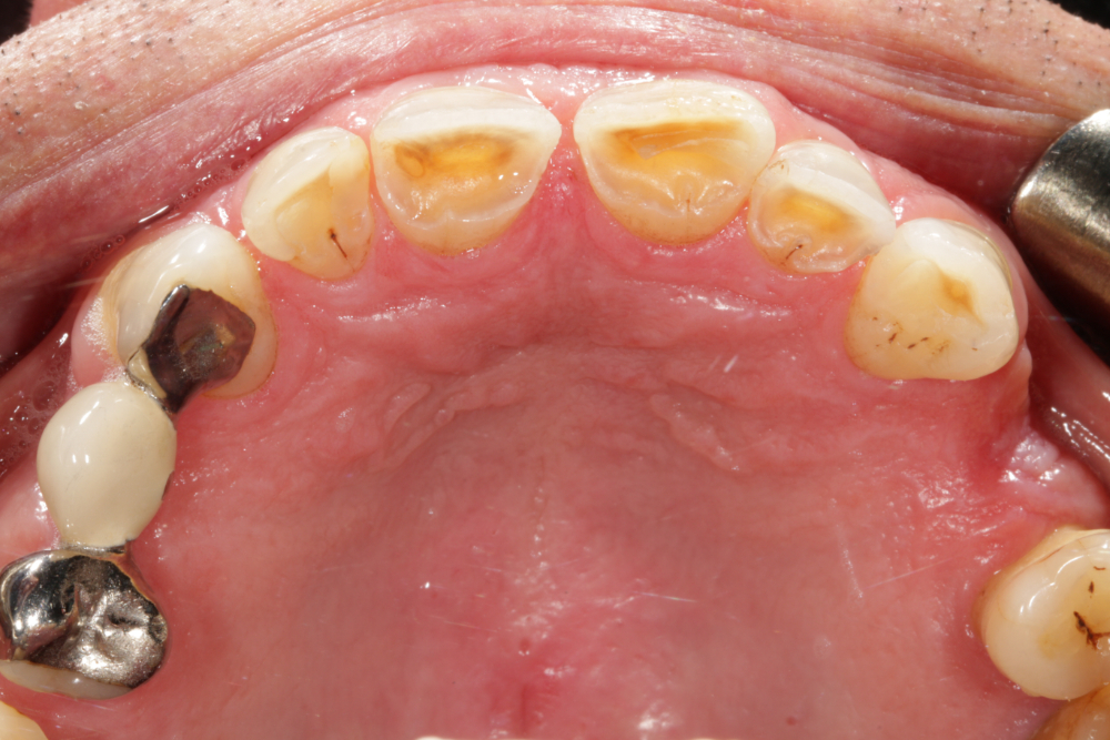 Worn Teeth