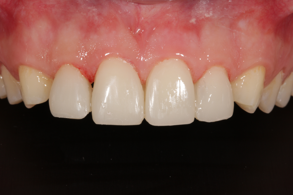 After Closing Gaps